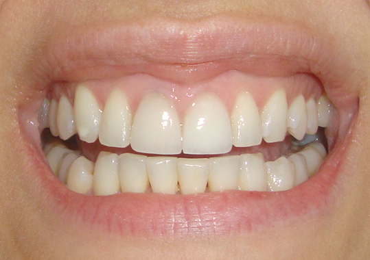 Crest 3D White 2 Hour Express Whitestrips before