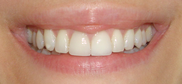 teeth whitening at home before and after