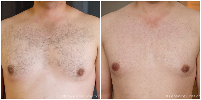 before and after laser hair removal treatment.png